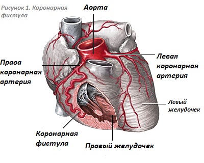 Коронарно легочная фистула что это у взрослых. Смотреть фото Коронарно легочная фистула что это у взрослых. Смотреть картинку Коронарно легочная фистула что это у взрослых. Картинка про Коронарно легочная фистула что это у взрослых. Фото Коронарно легочная фистула что это у взрослых