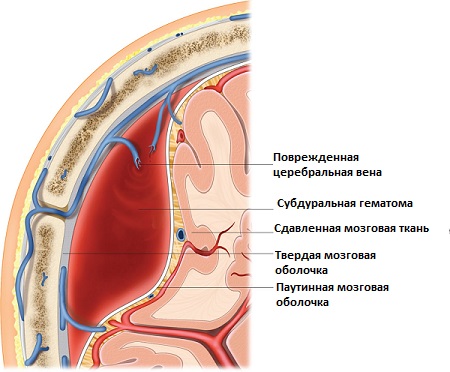 нетравматическое субдуральное кровоизлияние что это. Смотреть фото нетравматическое субдуральное кровоизлияние что это. Смотреть картинку нетравматическое субдуральное кровоизлияние что это. Картинка про нетравматическое субдуральное кровоизлияние что это. Фото нетравматическое субдуральное кровоизлияние что это нетравматическое субдуральное кровоизлияние что это. Смотреть фото нетравматическое субдуральное кровоизлияние что это. Смотреть картинку нетравматическое субдуральное кровоизлияние что это. Картинка про нетравматическое субдуральное кровоизлияние что это. Фото нетравматическое субдуральное кровоизлияние что это
