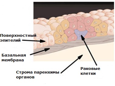 Что такое in situ в онкологии. Смотреть фото Что такое in situ в онкологии. Смотреть картинку Что такое in situ в онкологии. Картинка про Что такое in situ в онкологии. Фото Что такое in situ в онкологии