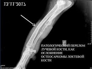 Что значит патологический перелом. Смотреть фото Что значит патологический перелом. Смотреть картинку Что значит патологический перелом. Картинка про Что значит патологический перелом. Фото Что значит патологический перелом