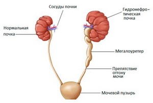 Что такое обструктивная уропатия и рефлюкс уропатия. Смотреть фото Что такое обструктивная уропатия и рефлюкс уропатия. Смотреть картинку Что такое обструктивная уропатия и рефлюкс уропатия. Картинка про Что такое обструктивная уропатия и рефлюкс уропатия. Фото Что такое обструктивная уропатия и рефлюкс уропатия