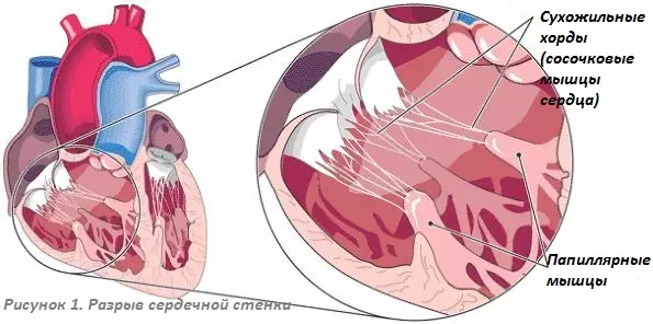 Разрыв сердечной стенки