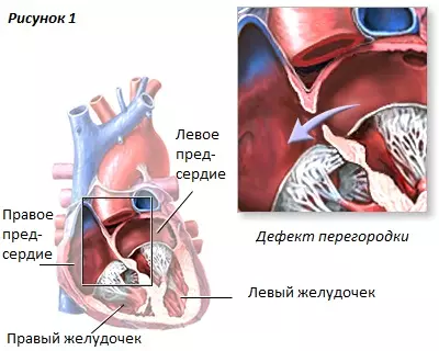 Дефект межжелудочковой перегородки сердца