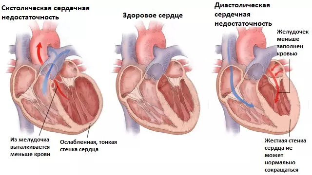 Застойная сердечная недостаточность