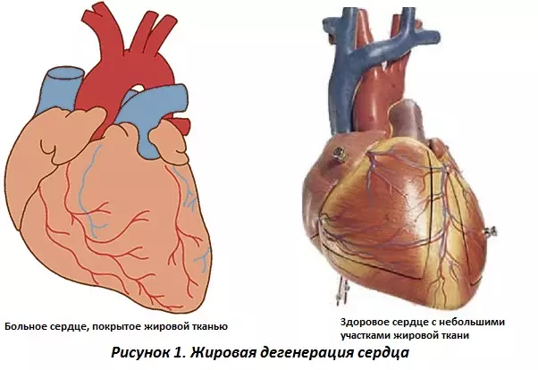 Жировая дистрофия сердца (ожирение сердца)