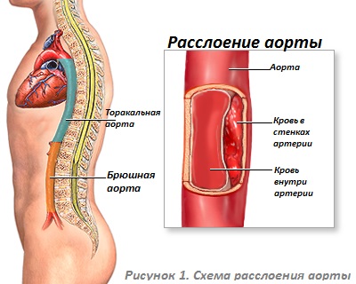 Схема расслоения аорты