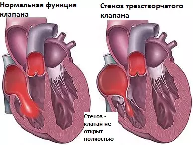 Стеноз трикуспидального клапана, недостаточность трикуспидального клапана