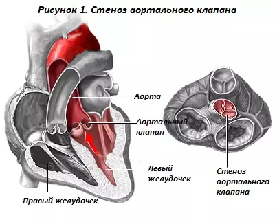 Ревматический аортальный стеноз (сужение аортального клапана)