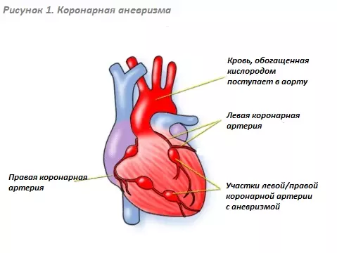 Аневризма коронарной артерии