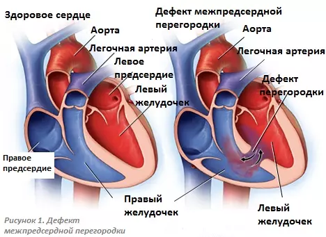 Дефект межпредсердной перегородки (ДМПП)