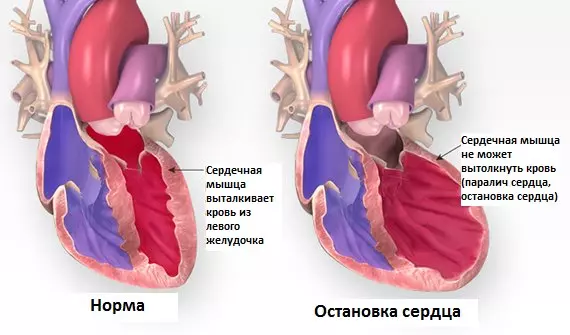 Остановка сердца