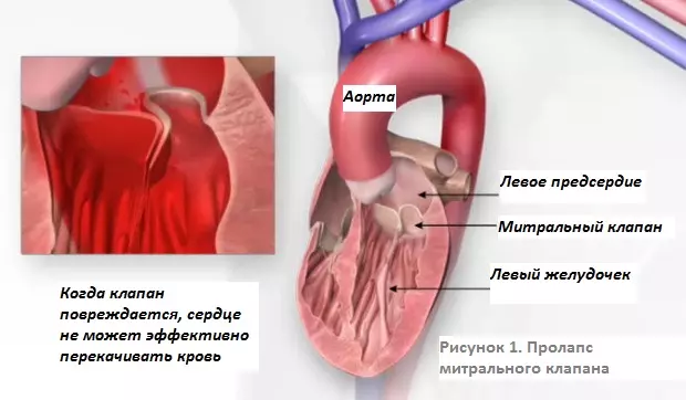 Причины и лечение пролапса митрального клапана