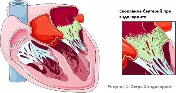 Острый и подострый инфекционный эндокардит