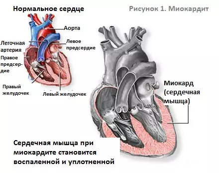 Острый и инфекционный миокардит