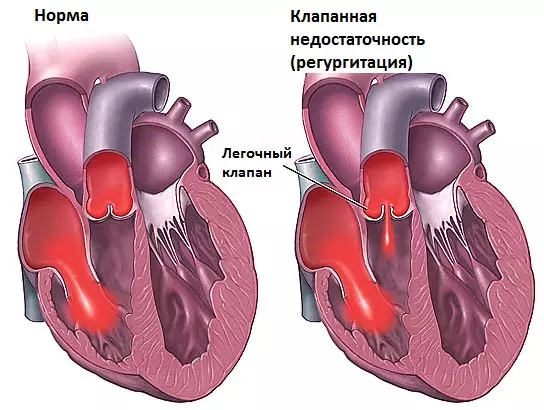 Недостаточность клапана легочной артерии