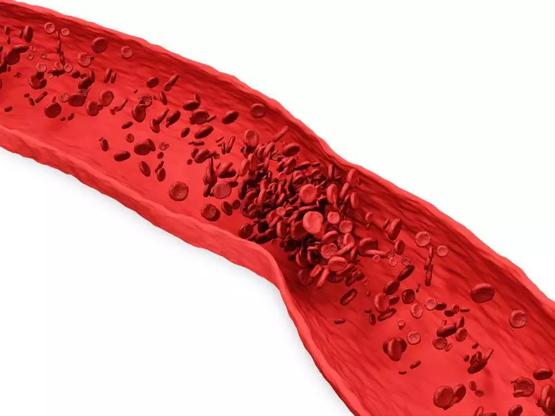 Тромбоз и эмболия артерий конечностей