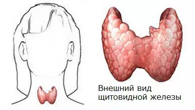 Эндемический кретинизм