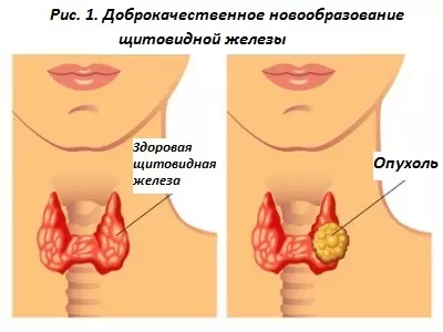Доброкачественные новообразования щитовидной железы