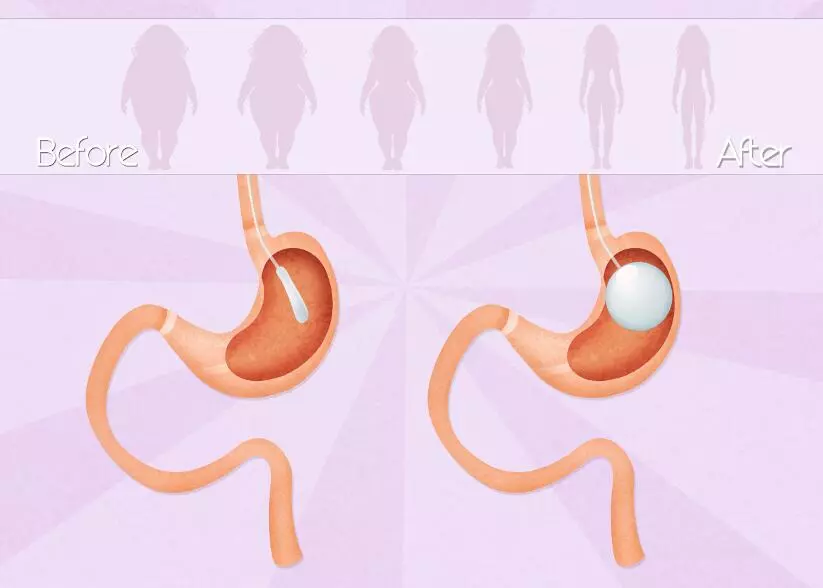 Лечение ожирения установкой внутрижелудочного баллона