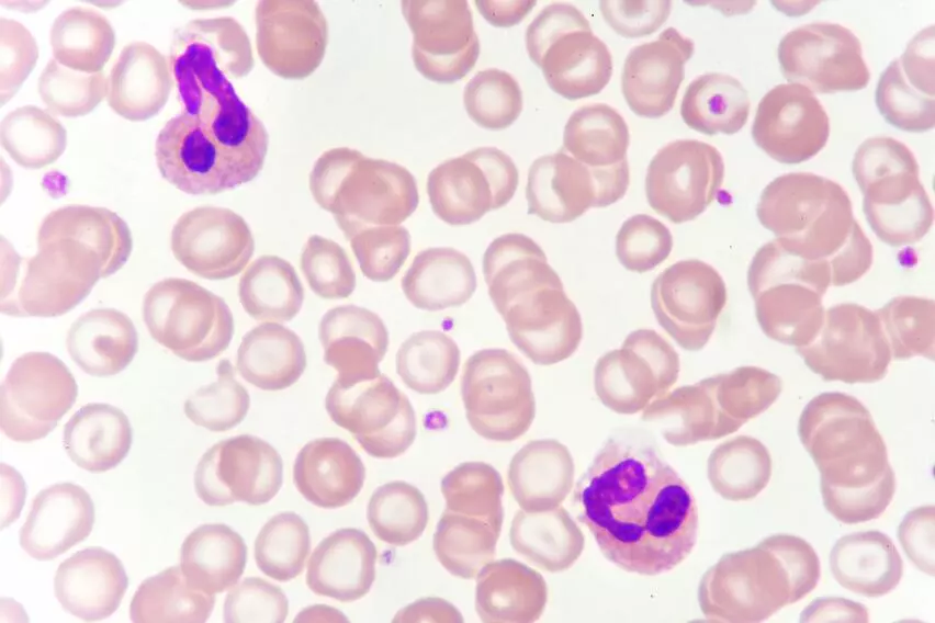 Нарушения свертываемости крови, гемофилия А и В