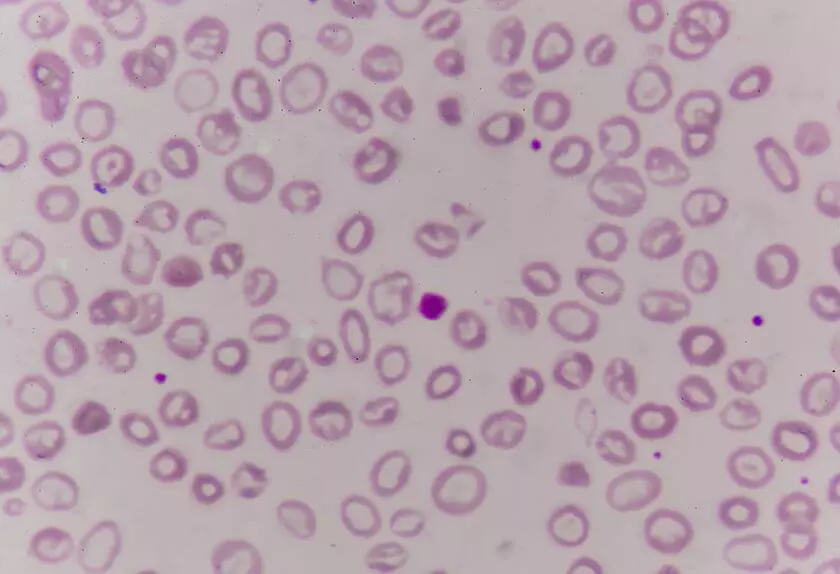 Гемофагоцитарный лимфогистиоцитоз. Гистиоцитозы из мононуклеарных фагоцитов, отличных от клеток Лангерганса