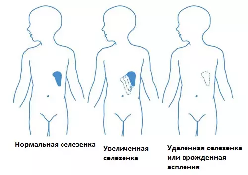 Гипоспленизм, аспления послеоперационная (атрофия селезенки)