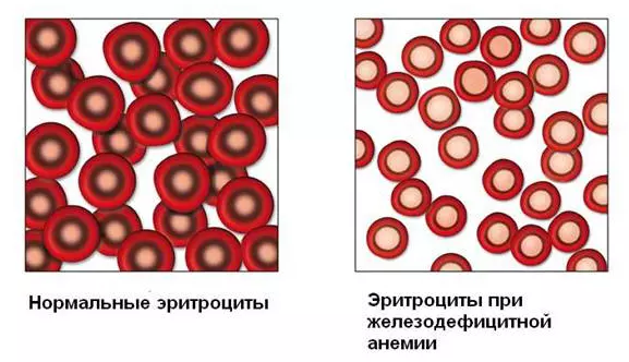 Железодефицитная анемия