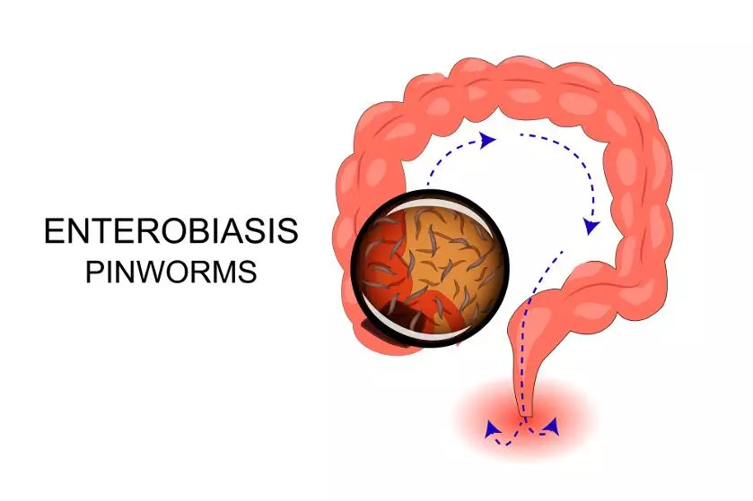 Что такое энтеробиоз, пути заражения острицами