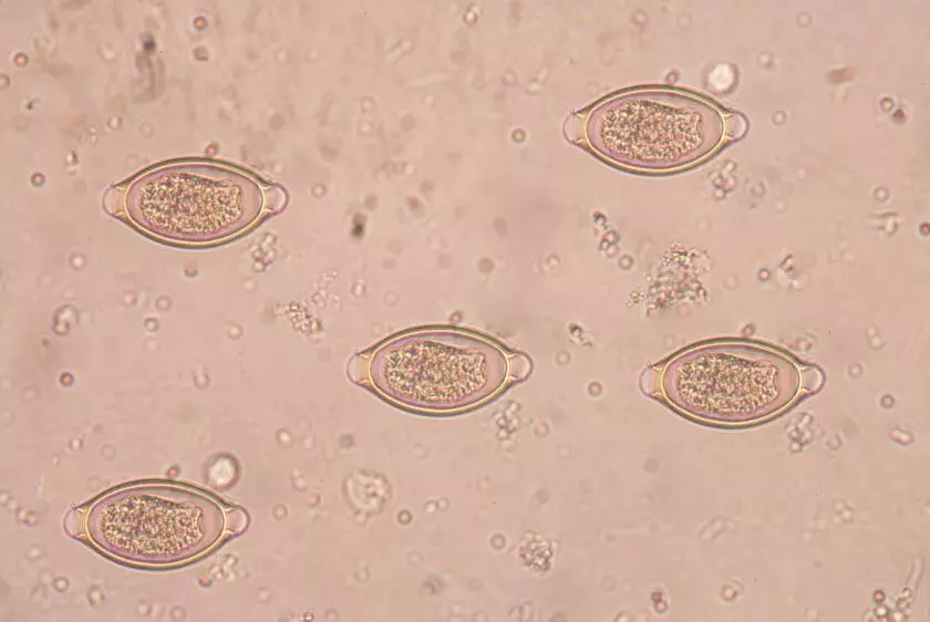 Что такое трихуроз (трихоцефалёз)?