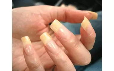 Синдром желтого ногтя