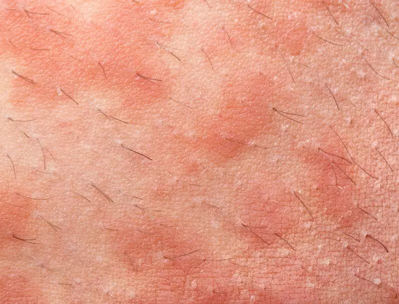 Лучевой дерматит и как его лечить