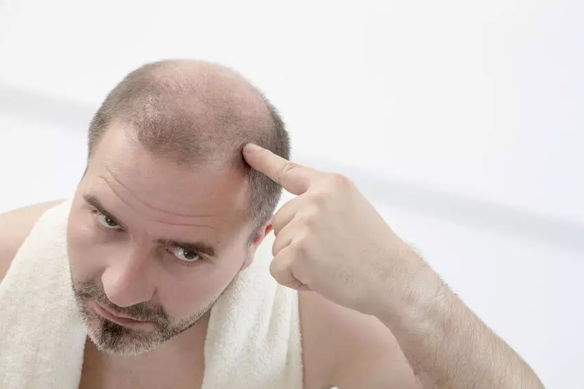 Гнездная алопеция, причины и лечение выпадения волос