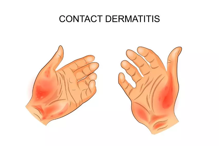 Контактный дерматит - аллергический и простой раздражительный