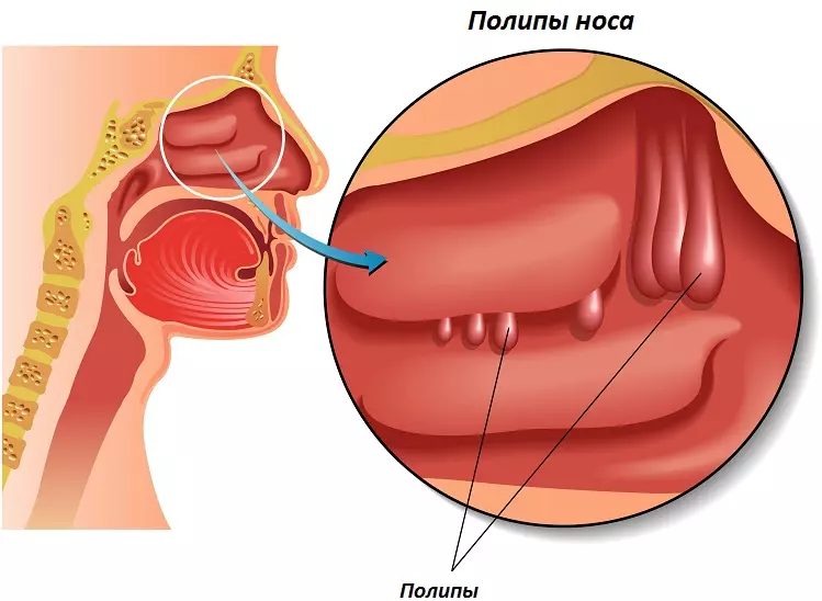 Полип носа