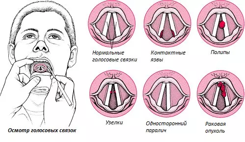 Паралич голосовых связок и гортани, полипы на голосовых связках и гортани