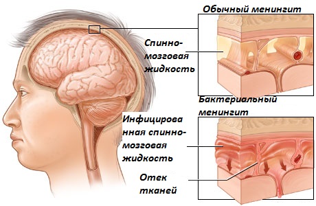 Головной мозг при менингите