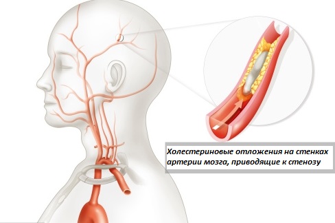 Стеноз мозговой артерии