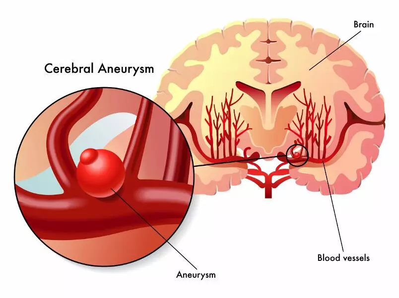 Аневризма мозга