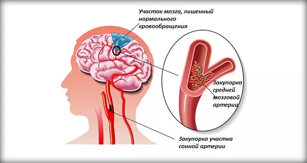 Стеноз и закупорка мозговых артерий