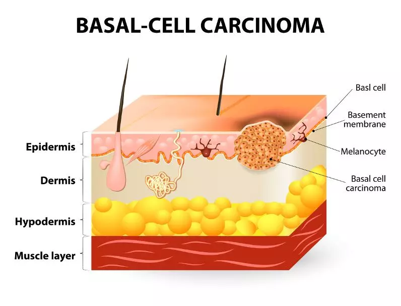 Карцинома in situ женских и мужских половых органов, щитовидной железы и других эндокринных желез