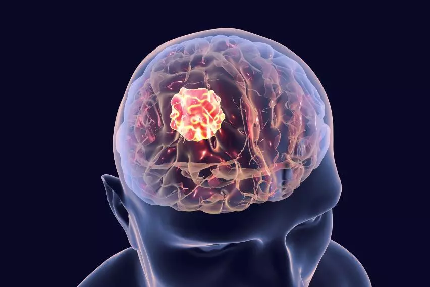 Доброкачественные новообразования мозговых оболочек, менингиомы