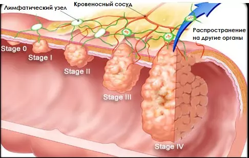 Рак брюшины и забрюшинного пространства