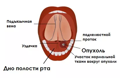 Рак дна полости рта