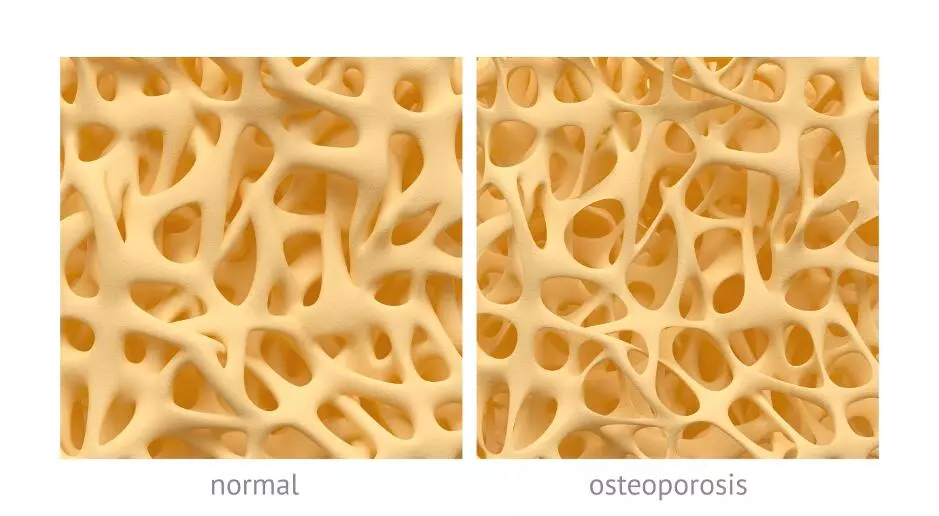 Остеопороз или пористые кости