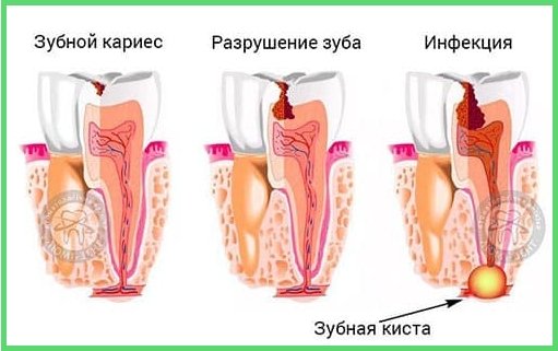 Способы лечения кисты зуба в клинике «Люми-Дент» Способы лечения кисты зуба в клинике «Люми-Дент»