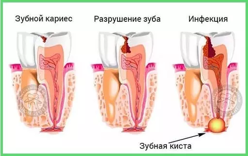Способы лечения кисты зуба  в клинике «Люми-Дент»