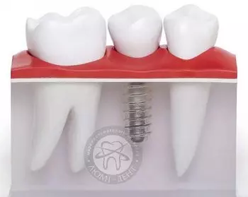 Имплантация зубов - преимущества и выбор клиники