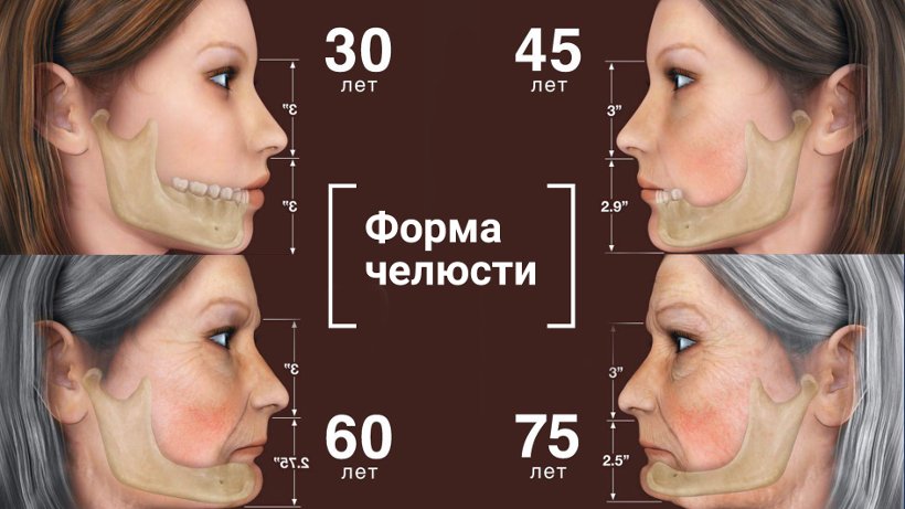 Имплантация при полной адентии Имплантация при полной адентии