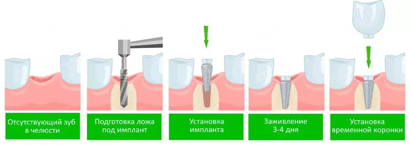 Протезирование нижней челюсти