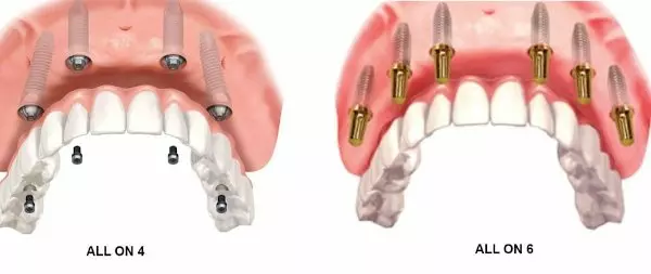 Аll-on-4 и All-on-6: в чем разница